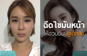 ฉีดไขมันหน้า
