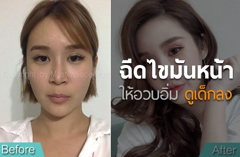 ฉีดไขมันหน้า