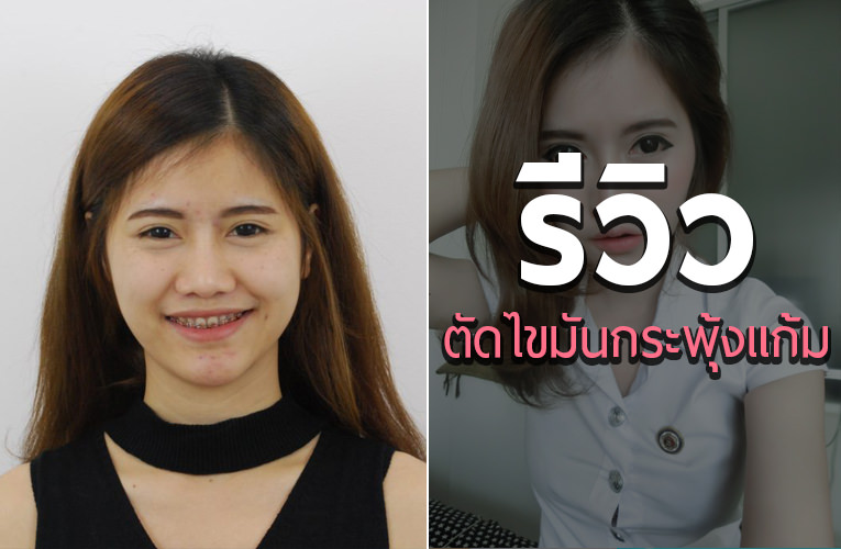 ตัดไขมันกระพุ้งแก้ม