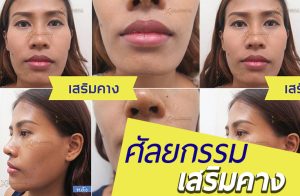 รีวิวเสริมคาง