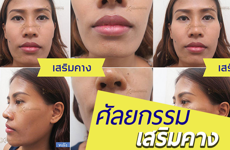 รีวิวเสริมคาง